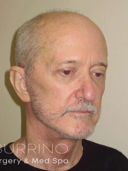 Facelift Before & After Patient #1675