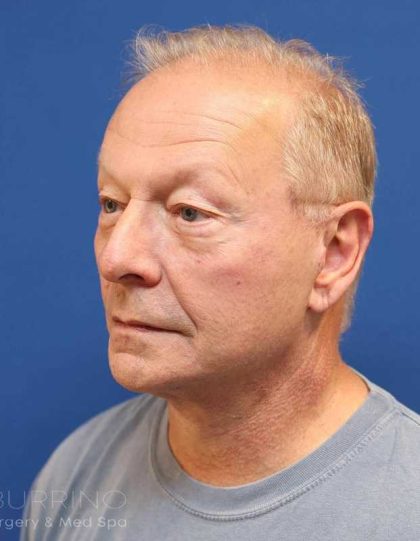 Facelift Before & After Patient #1693