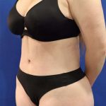 Lower Body Lift Before & After Patient #598
