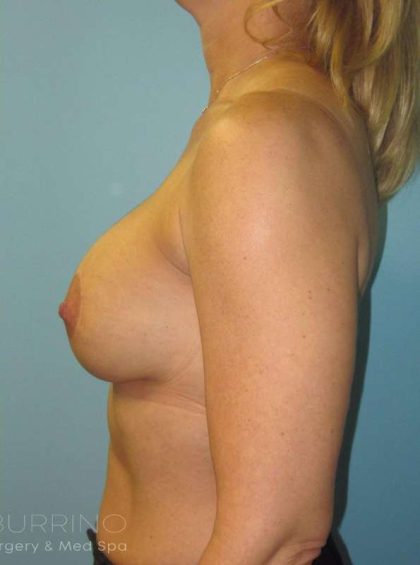 Breast Lift Before & After Patient #1902