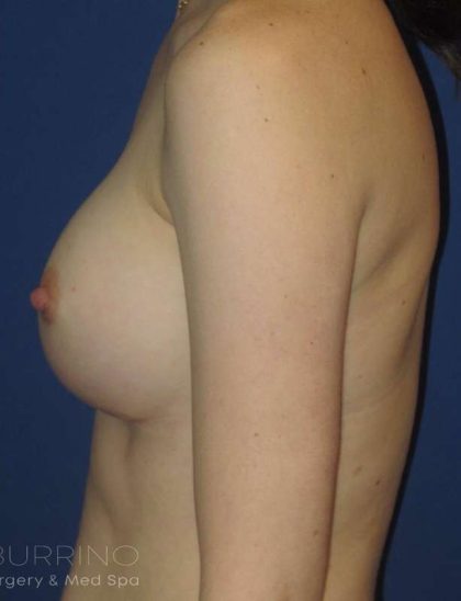 Breast Augmentation Before & After Patient #2081