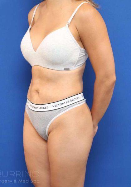 Liposuction Before & After Patient #668