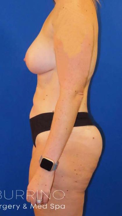 Liposuction Before & After Patient #702