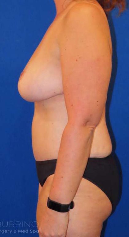 Liposuction Before & After Patient #718