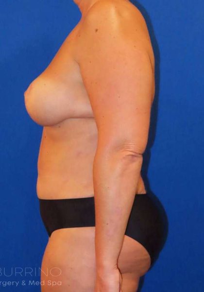 Liposuction Before & After Patient #777
