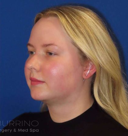 Liposuction Before & After Patient #813