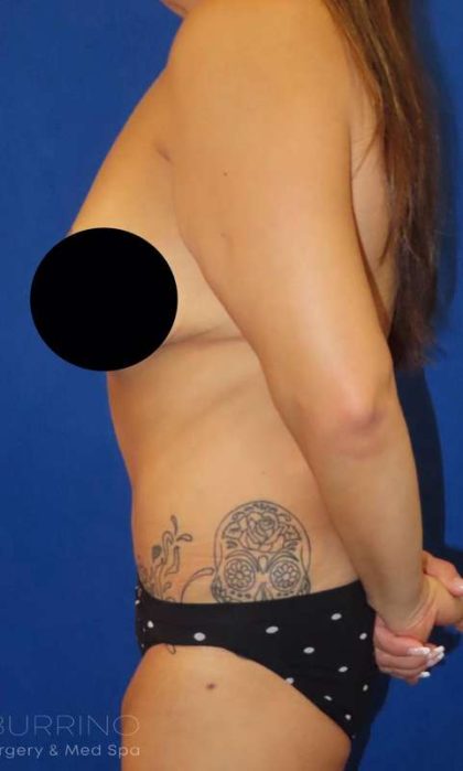 Body Contouring Before & After Patient #1038