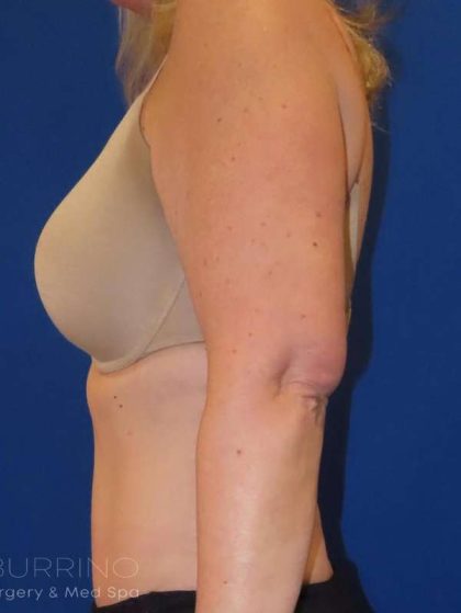 Body Contouring Before & After Patient #1065