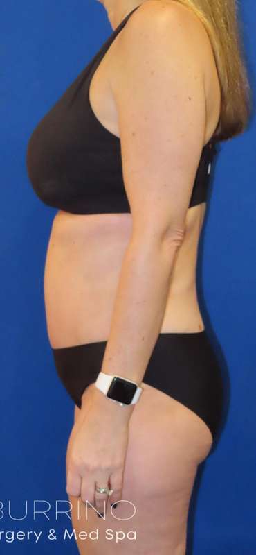 Tummy Tuck Before & After Patient #1190