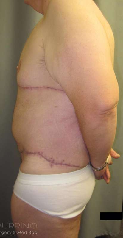 Tummy Tuck Before & After Patient #1225