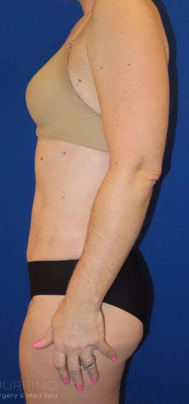 Tummy Tuck Before & After Patient #1236