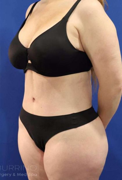 Tummy Tuck Before & After Patient #1356
