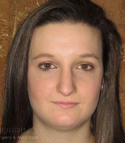 Rhinoplasty Before & After Patient #1406