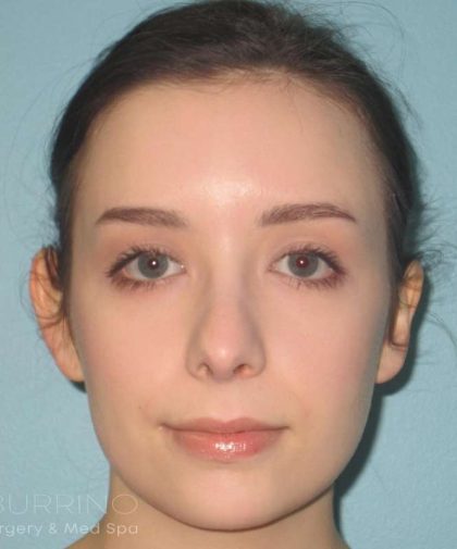Rhinoplasty Before & After Patient #1439