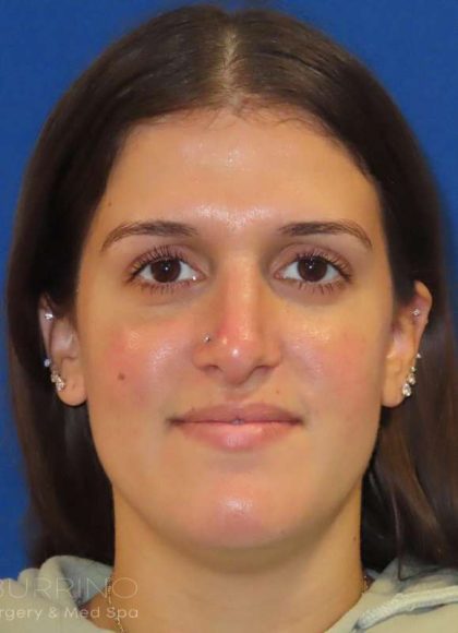 Rhinoplasty Before & After Patient #1454