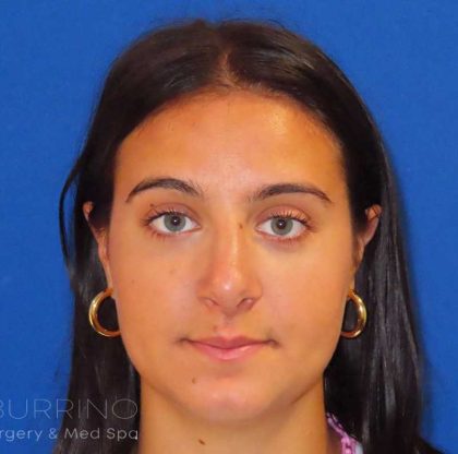 Rhinoplasty Before & After Patient #1465