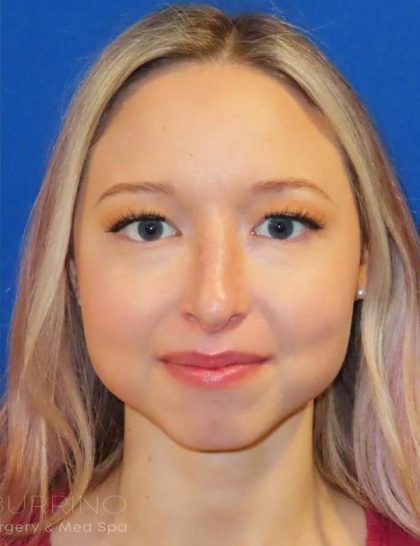 Rhinoplasty Before & After Patient #1476