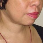 Neck Lift Before & After Patient #1498