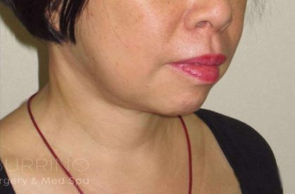 Neck Lift Before & After Patient #1498