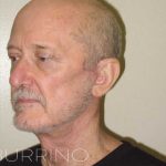 Neck Lift Before & After Patient #1509