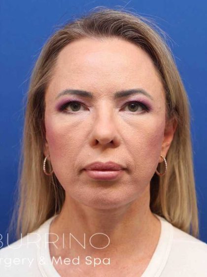 Neck Lift Before & After Patient #1538