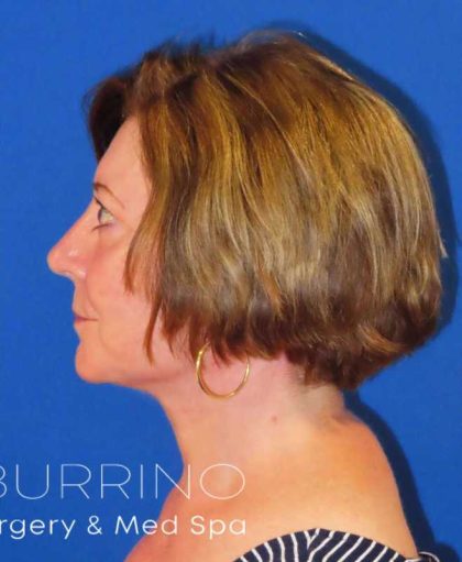 Neck Lift Before & After Patient #1549