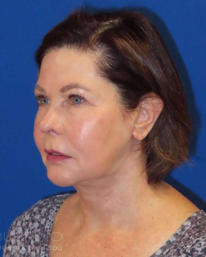 Neck Lift Before & After Patient #1578