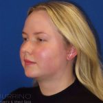 Neck Lift Before & After Patient #1589