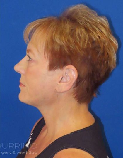 Facelift Before & After Patient #1620