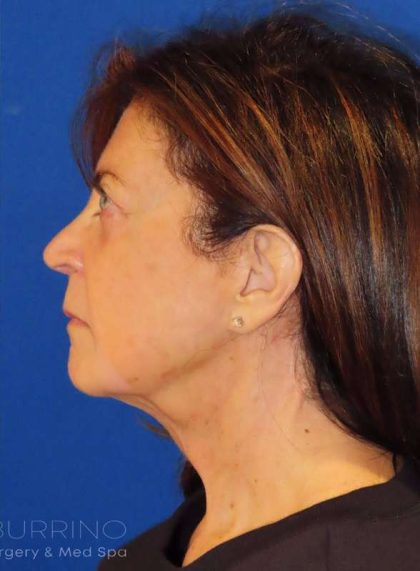 Facelift Before & After Patient #1631