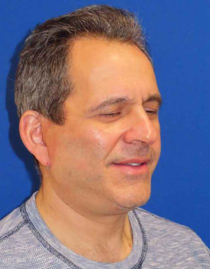 Facelift Before & After Patient #1653