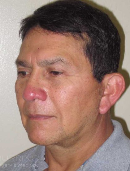 Facelift Before & After Patient #1664