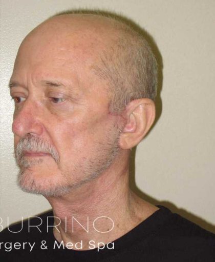 Facelift Before & After Patient #1675