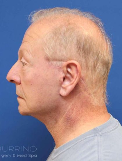Facelift Before & After Patient #1693