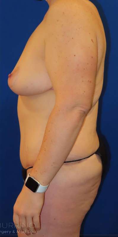 Breast Reduction Before & After Patient #1819