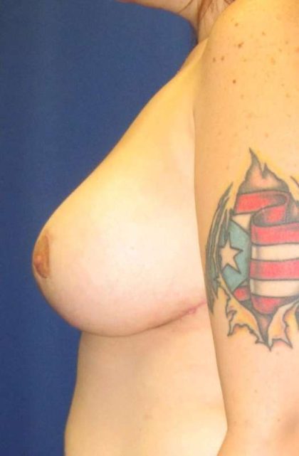 Breast Lift Before & After Patient #1891
