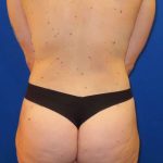 Liposuction Before & After Patient #702