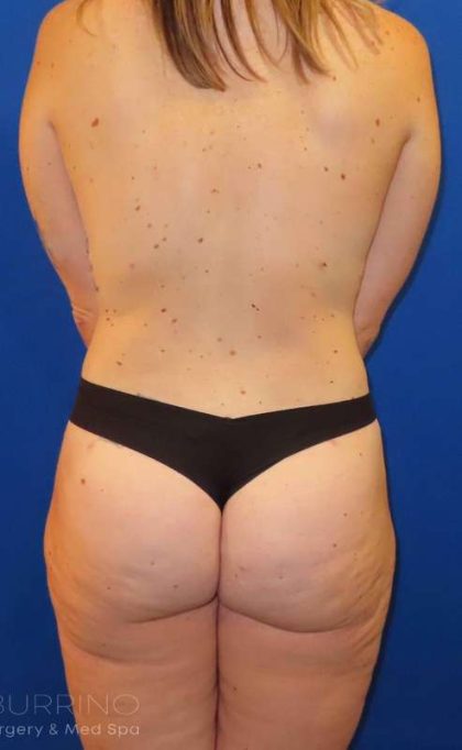 Liposuction Before & After Patient #702