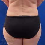 Liposuction Before & After Patient #731
