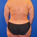 Liposuction Before & After Patient #777