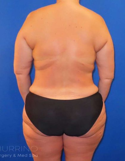 Liposuction Before & After Patient #777