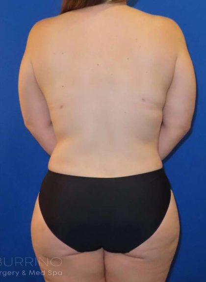 Mommy Makeover Before & After Patient #513