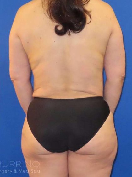Fat Transfer Before & After Patient #891