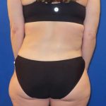 Tummy Tuck Before & After Patient #1190
