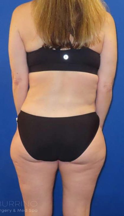 Tummy Tuck Before & After Patient #1190