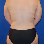 Tummy Tuck Before & After Patient #1249