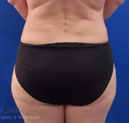 Tummy Tuck Before & After Patient #1273