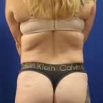 Tummy Tuck Before & After Patient #1369