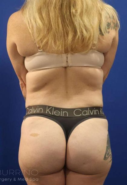 Tummy Tuck Before & After Patient #1369