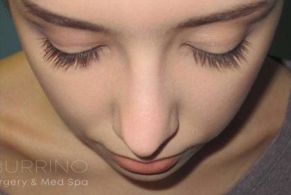 Rhinoplasty Before & After Patient #1439